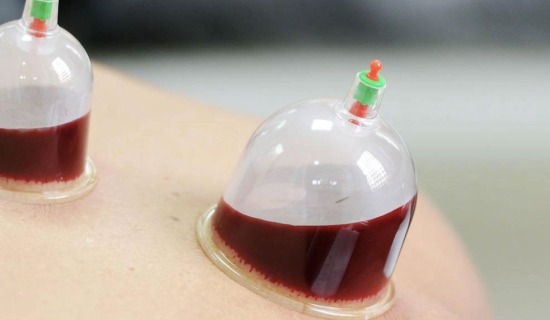 Kimlere Hacamat Yapılmaz ?